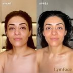 drainage lymphatique visage avant apres